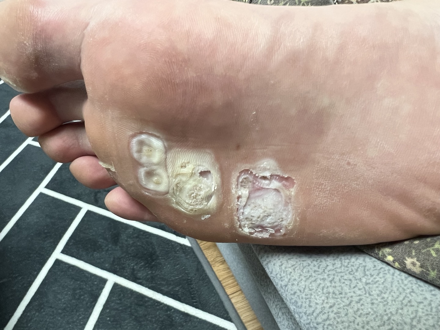 발바닥 사마귀치료과정