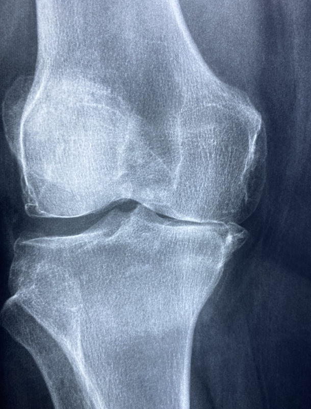 퇴행성 관절염 예방 및 관리법 – 무릎 건강을 지키는 생활 습관