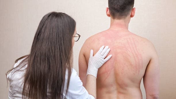 두드러기 진단법: 병원에서 받는 검사와 과정