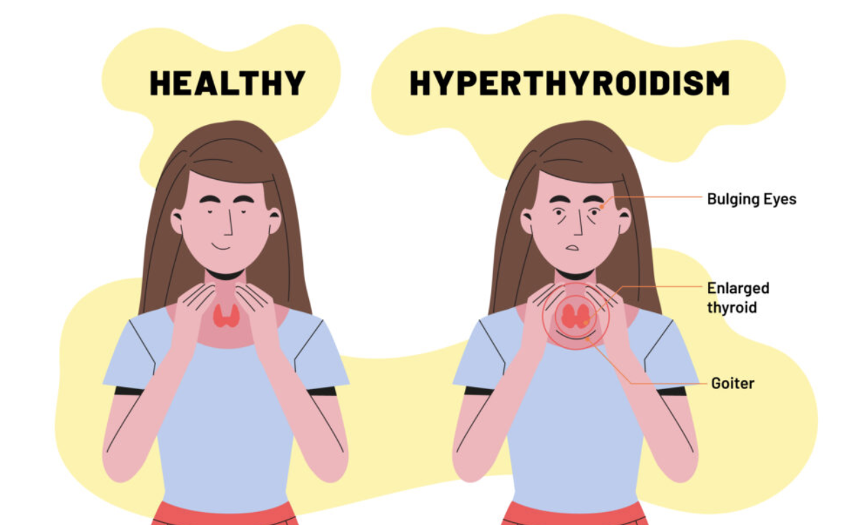 갑상선 기능 저하증 증상 2