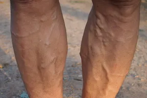 하지정맥-치료-방법