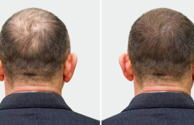 남성 탈모