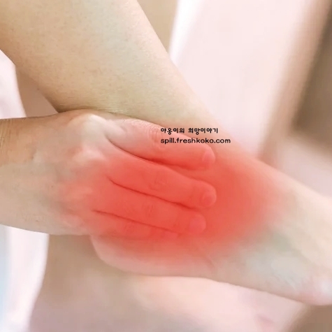 통풍 증상