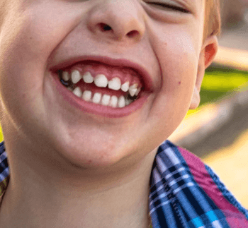 구내염 원인 - 아프타성