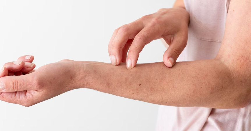 땀띠를 예방하는 방법