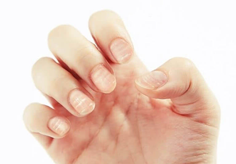 건선이 생긴 손톱