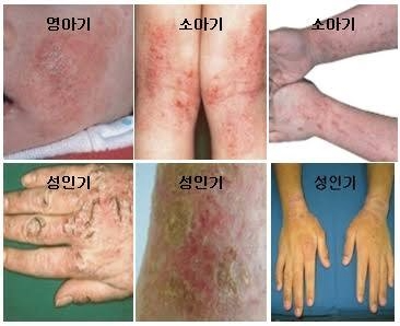 아토피피부염 증상.치료.생활습관과 스트레스관리
