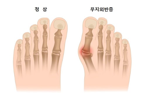 무지외반증 증상.치료방법.생활속관리