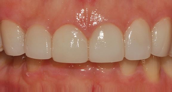 라미네이트 시술 후