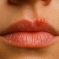 입술에 물집이 생기는 이유