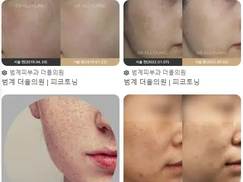 피코토닝