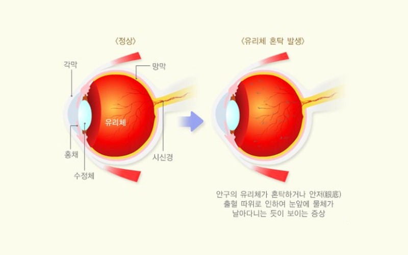 비문증의 원인과 증상