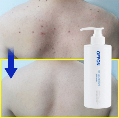 지성 피부 (등드름, 가드름) 바디 워시