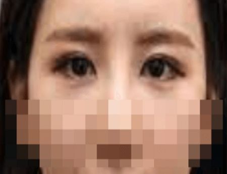 아이캐번 실리프팅 시술 후 사진 예시