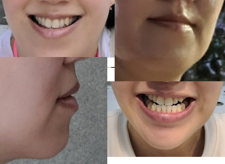 교정-전-치아-상태