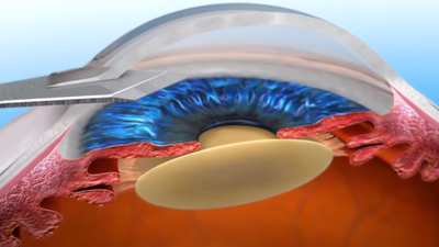 백내장 수술 발전과 인공수정체의 중요성 관련 이미지