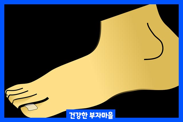 통풍 증상, 바람만 스쳐도 아픈 원인 및 치료법 - 통풍 증상 - 치료법 치료법, 약물, 체중 관리, 식이요법