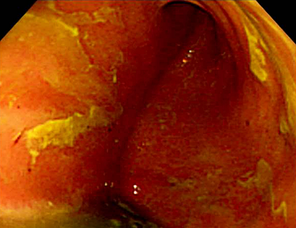 담즙 역류성위염1_출처:EndoToday