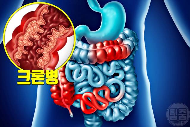 차전자피 효능 부작용 하루권장량 매일 크론병 과민성대장증후군