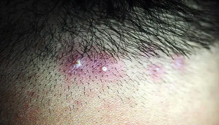 모발이식 3000모 비용, 부작용 정리