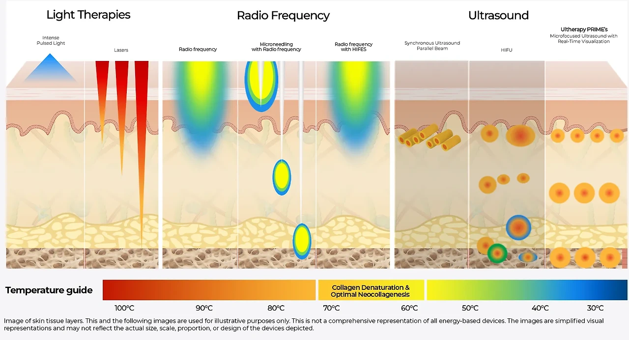 울쎄라 써마지 &mdash; 원리&middot;효과&middot;차이 완전 비교