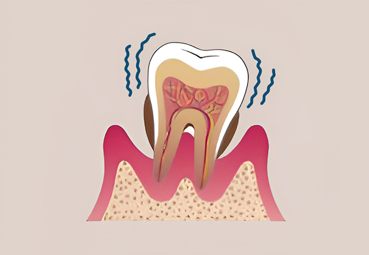 염증이-심한-잇몸의-모습