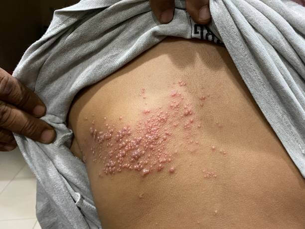대상포진 초기증상