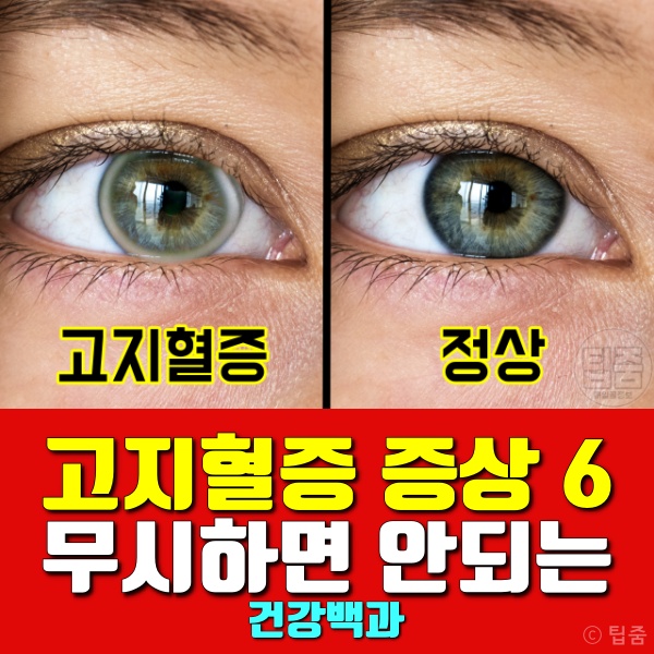 고지혈증 증상 초기증상 고지혈증원인