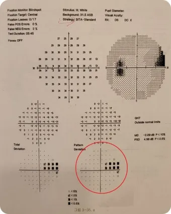 녹내장 진단 검사 비용 안압 검사주기 관리법_10