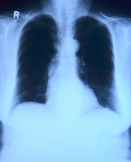 식도암은 식도라 불리는 기관에서 발생하는 악성 종양으로 , 주로 식도의 점막에서 시작하여 발전한다