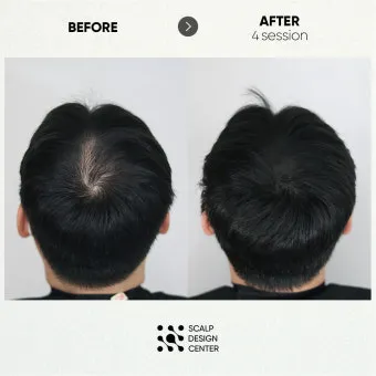 정수리가 아픈 이유와 완화하는 방법_17