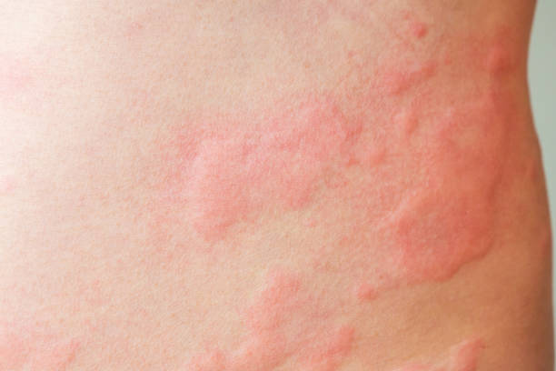 콜린성두드러기의 원인과 증상