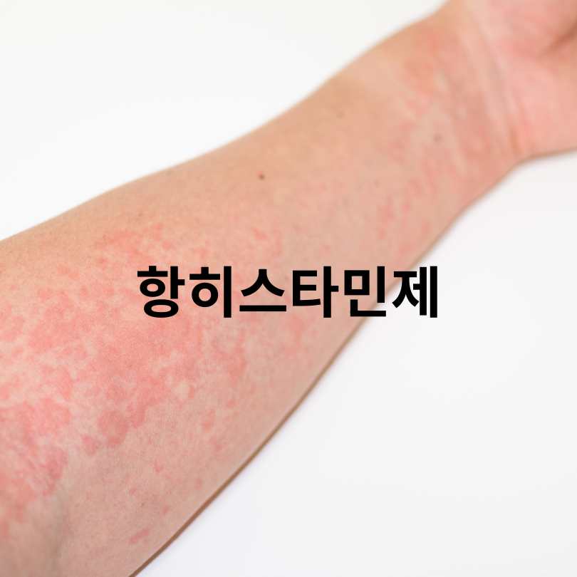 두드러기 간지러움 심할 때 해결방법과 원인