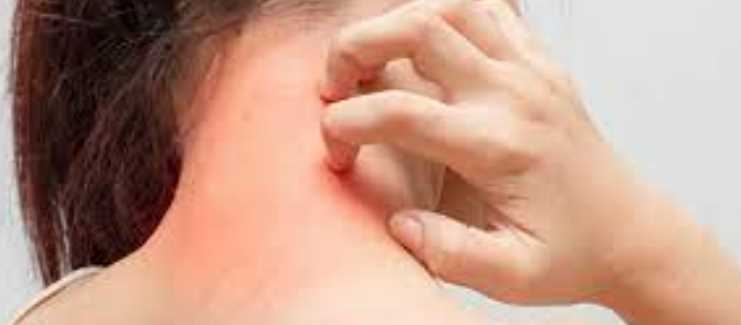 연근 효능 - 알레르기 개선