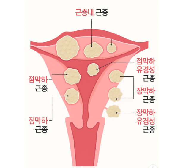 자궁근종 3가지 유형