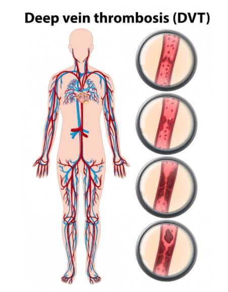 혈관마다 노페물의 정도
