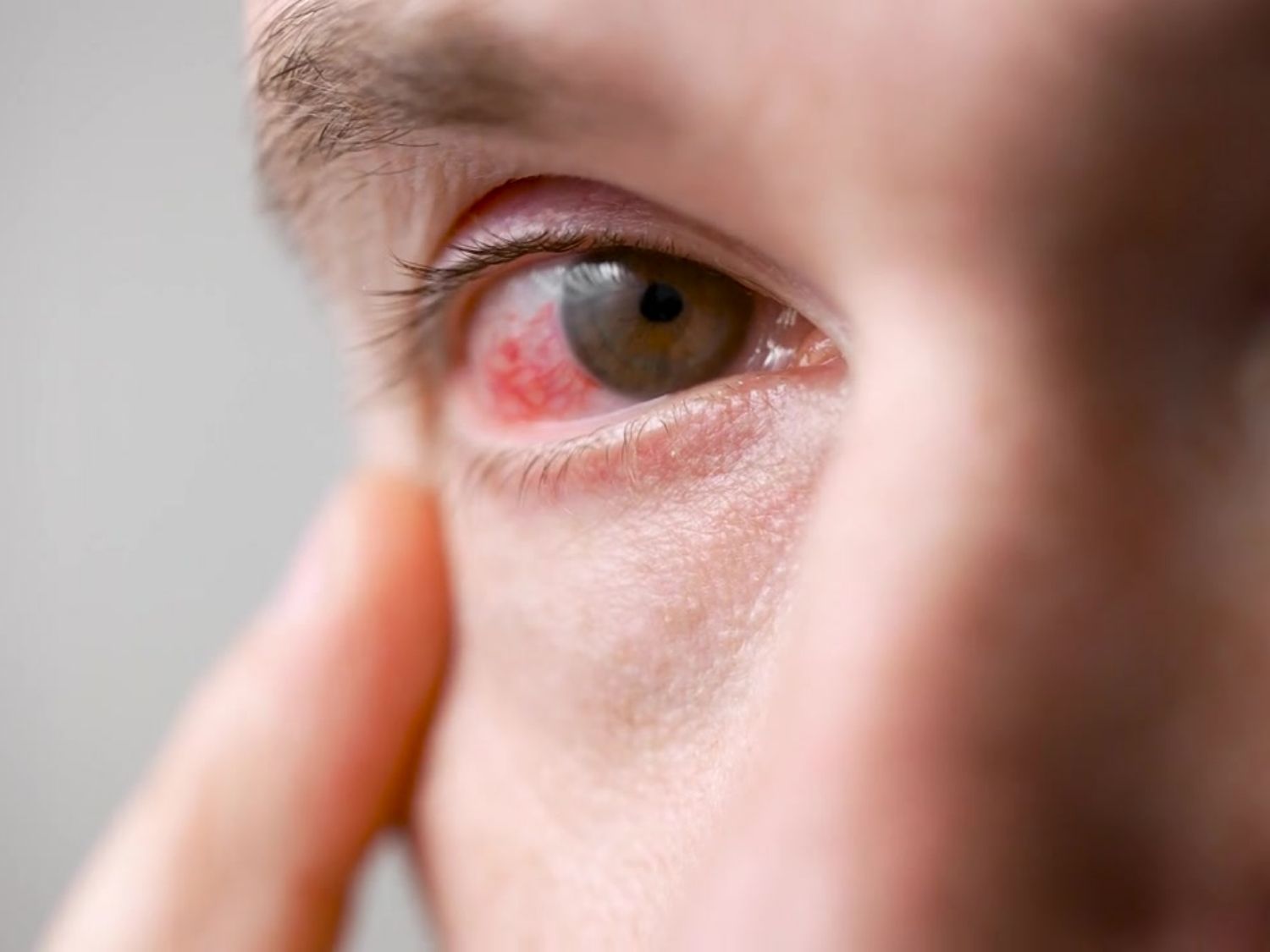 안구건조증 충혈 현상