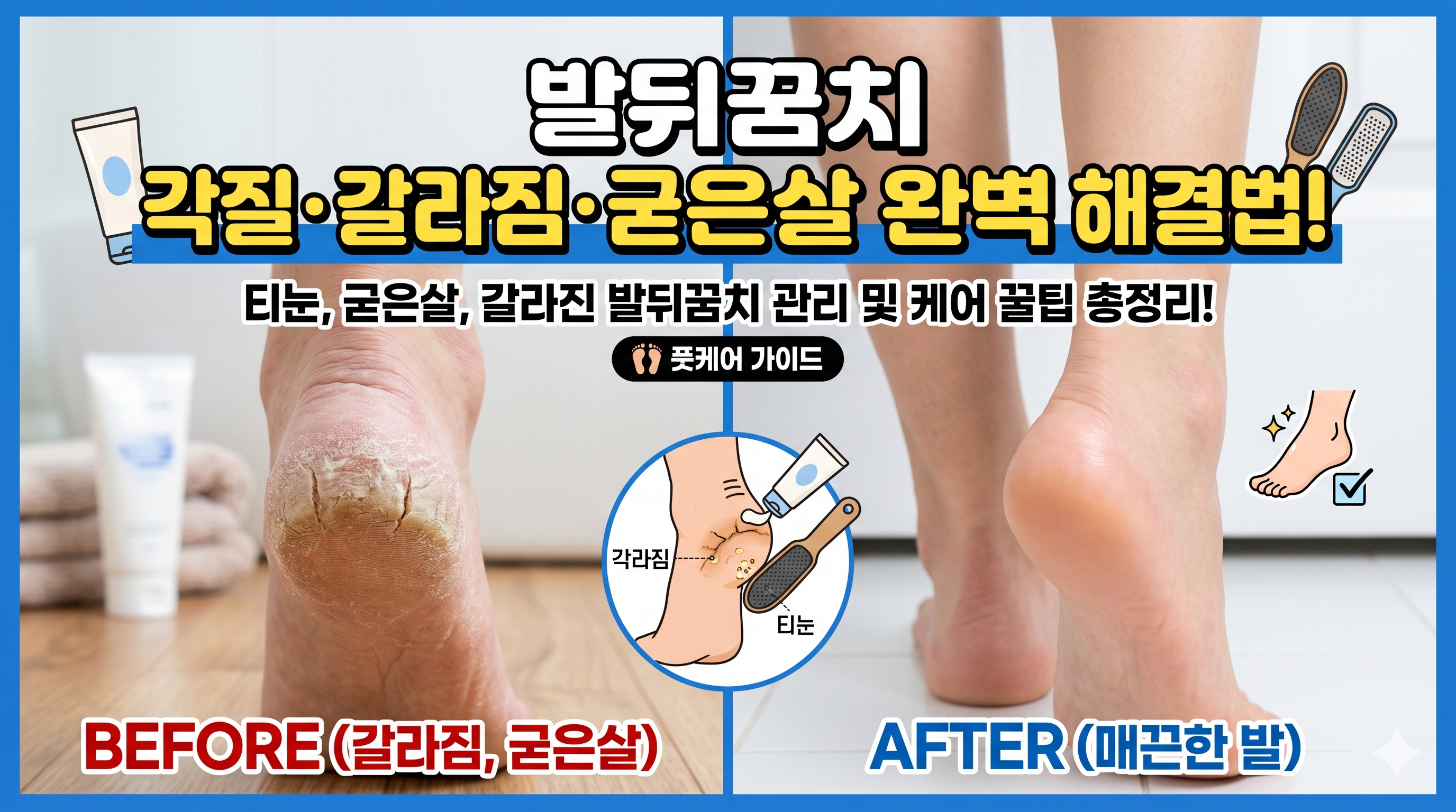 발뒤꿈치 각질(갈라짐,굳은살,티눈)사진