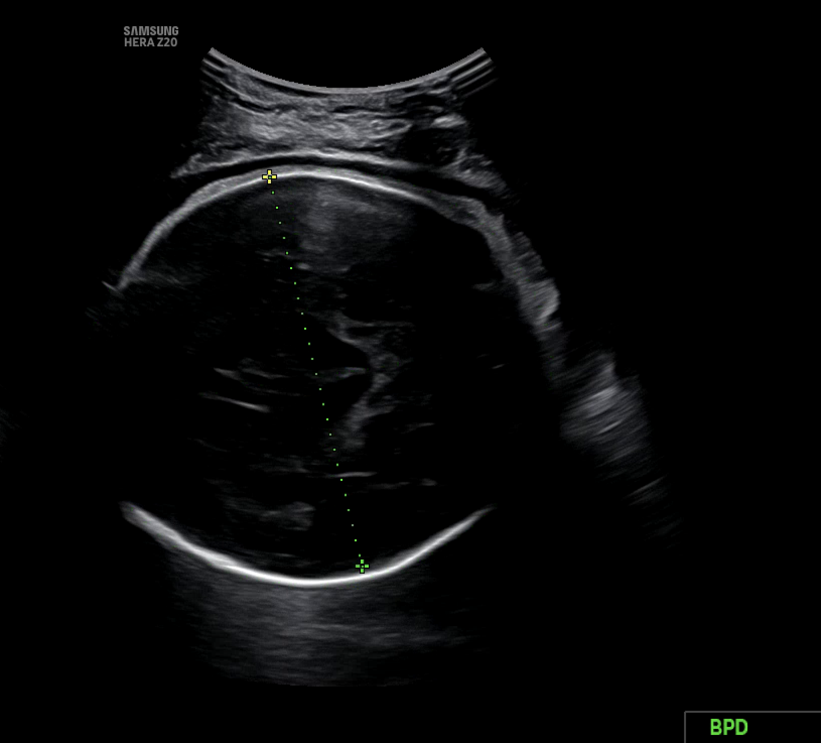 분류 클래스 예시 (bpd)