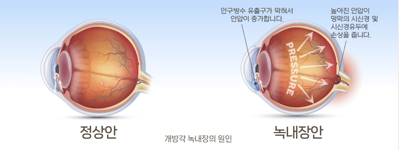 녹내장안