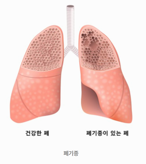 폐기종 이미지사진