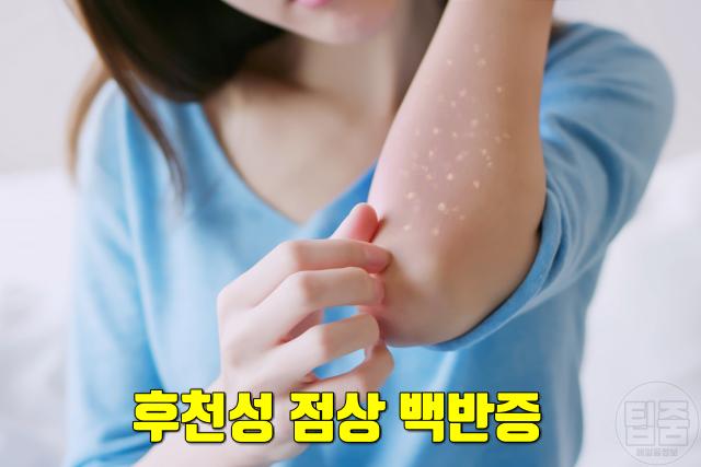 피부에 흰점 생기는 이유 후천성 점상 백반증 얼굴흰점 원인