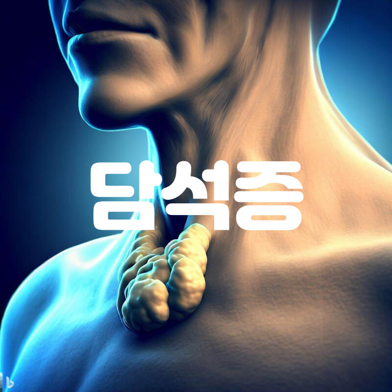 담석증
