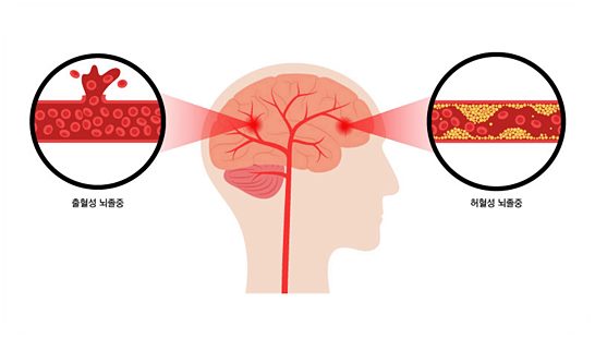 뇌졸중 뇌출혈 골든타임