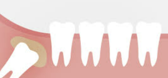 사랑니 발치후 식사 알아보기 커피, 흡연, 음주 정보