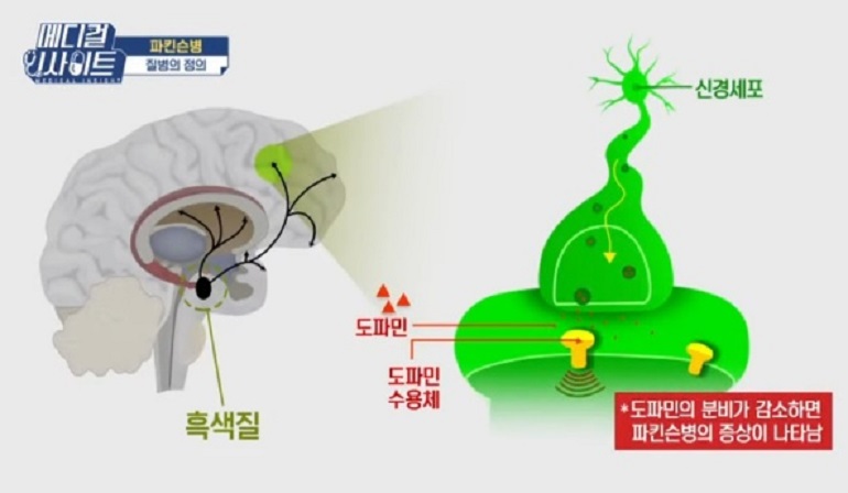 파킨슨병-정의
