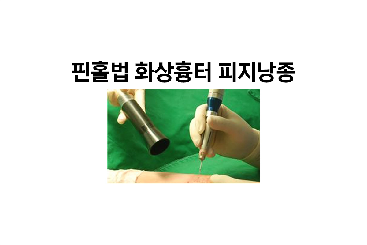 핀홀법 화상흉터 피지낭종 넓은 화상흉터 패인흉터