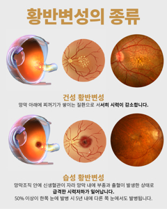 망막변성
