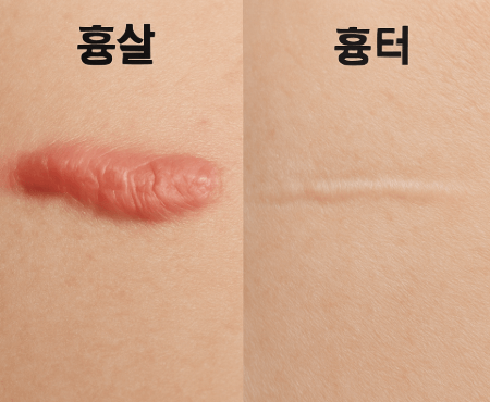 흉살과 흉터 비교