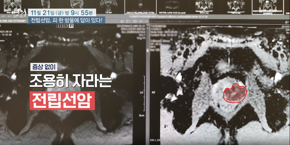 몀의 전립선암 피한방울